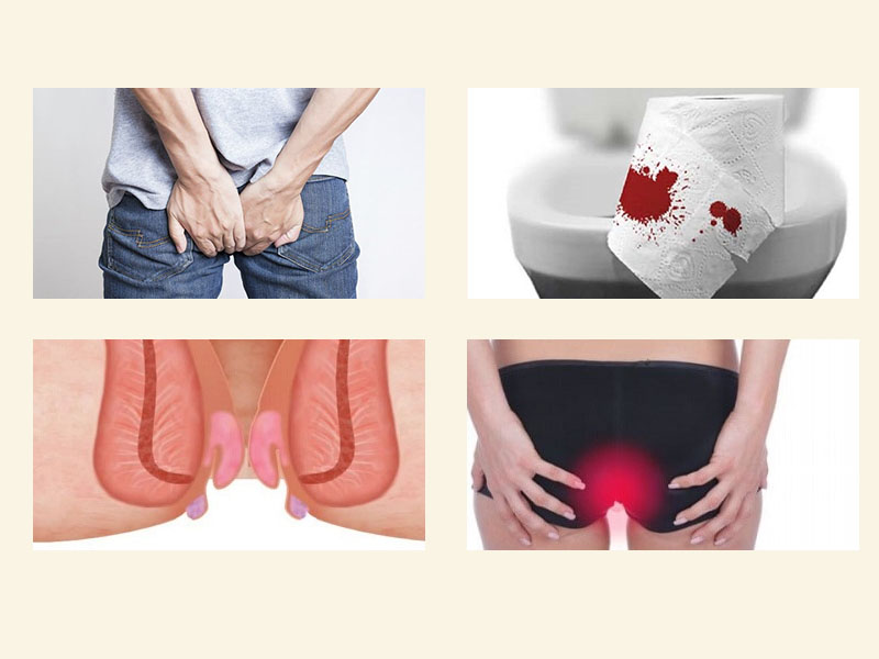 Biểu hiện của bệnh trĩ sau sinh