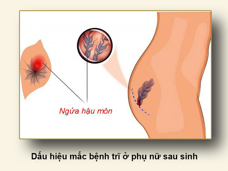 Dấu hiệu mắc bệnh trĩ ở phụ nữ sau sinh