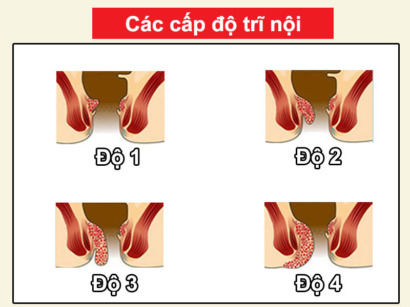 Các cấp độ bệnh trĩ