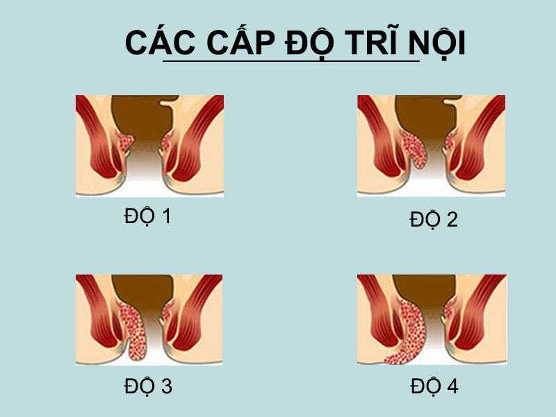 Các cấp độ trĩ nội