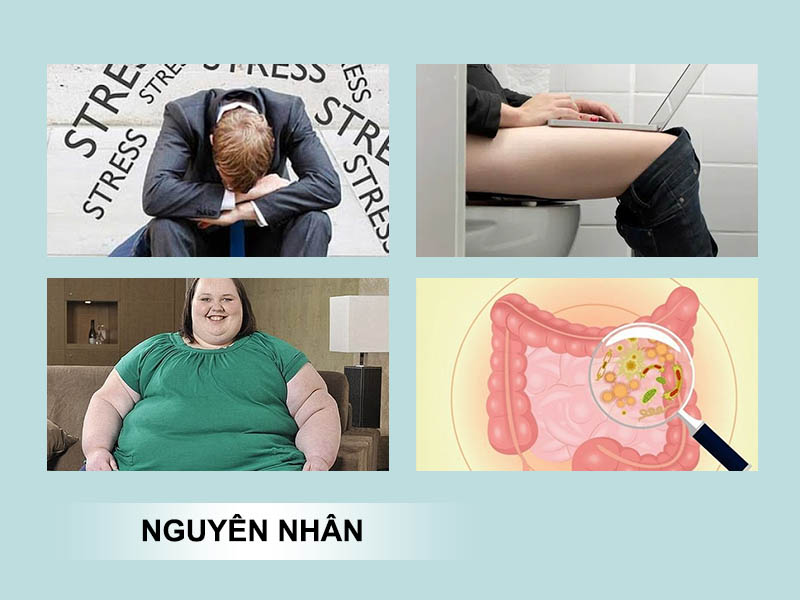 Nguyên nhân gây trĩ nội