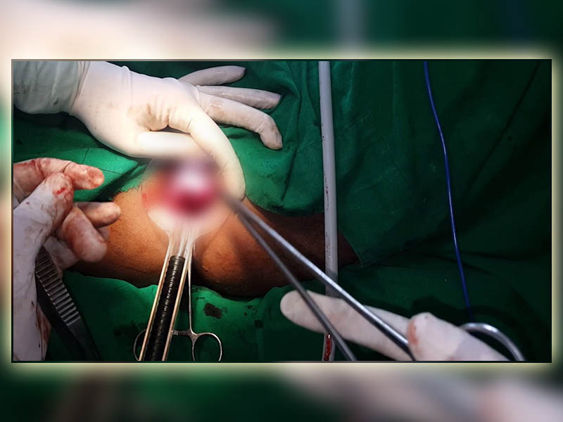 Phẫu thuật ngoại khoa chữa trĩ nội