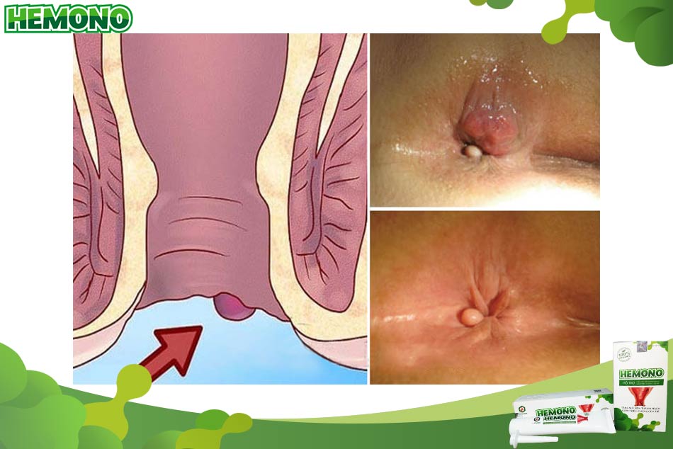 Triệu chứng của bệnh trĩ giai đoạn đầu