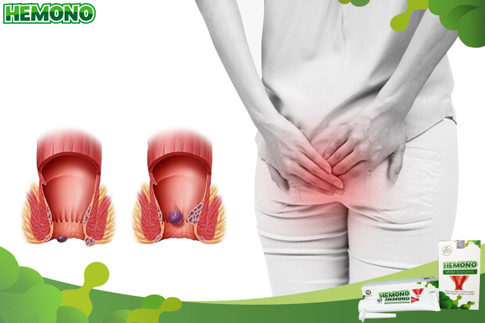 Đau rát hậu môn có phải là dấu hiệu của bệnh trĩ
