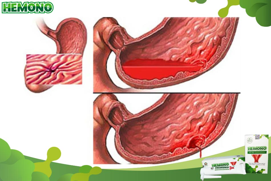 Xuất huyết tiêu hóa khiến đi ngoài có máu đen