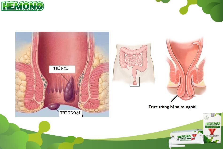 Cách phân biệt sa trực tràng và bệnh trĩ