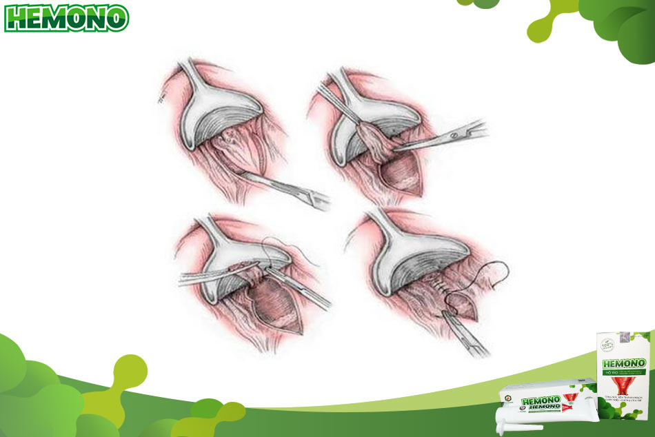 Phẫu thuật khoanh niêm mạc cắt trĩ