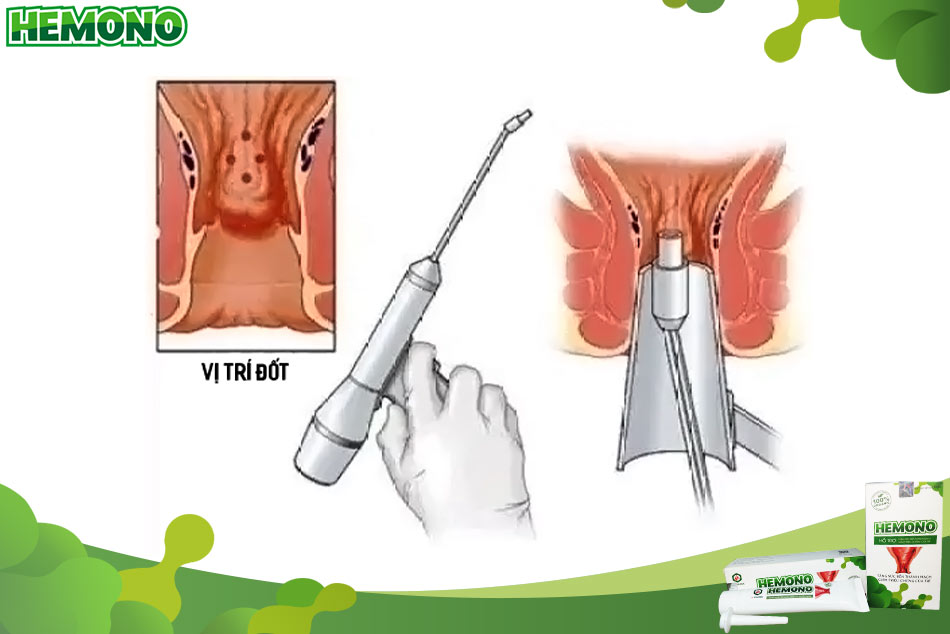 Cắt trĩ bằng tia Laser