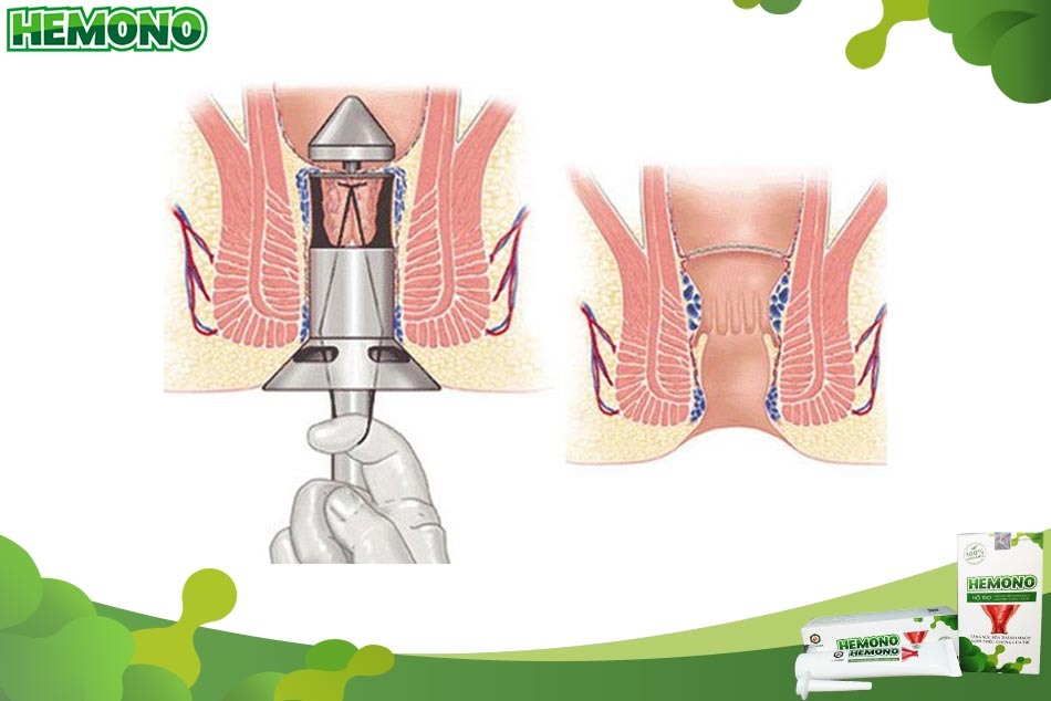 Cắt trĩ bằng phương pháp Longo