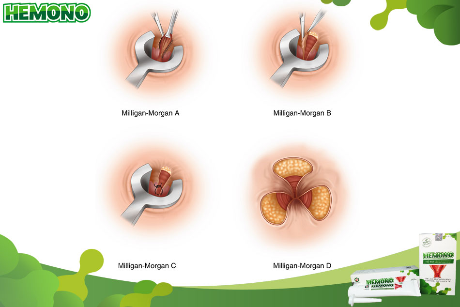 Phẫu thuật cắt trĩ bằng phương pháp Milligan Morgan