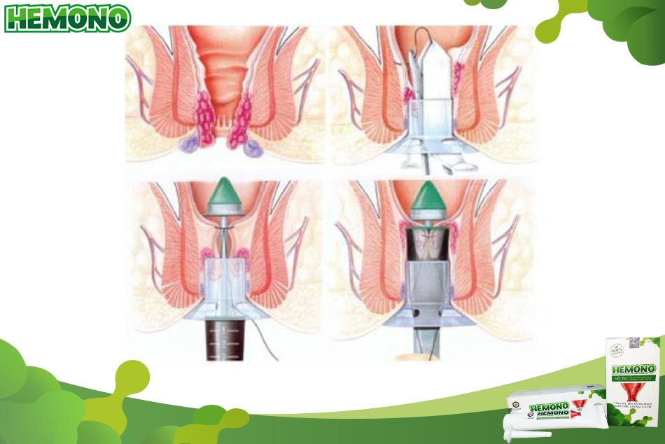 Phương pháp cắt trĩ PPH giúp phục hồi tổn thương nhanh