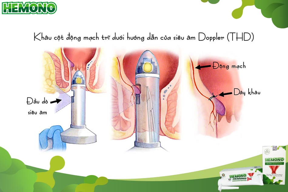 Cắt trĩ bằng phương pháp siêu âm Doppler – THD