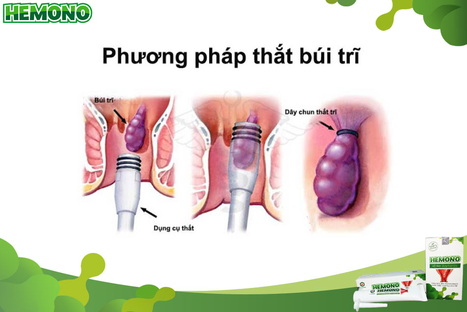Quy trình thực hiện phương pháp thắt búi trĩ đầy đủ