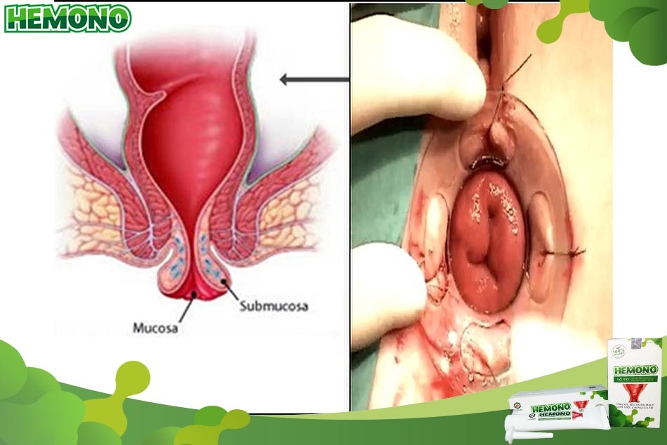 Biểu hiện của bệnh lý sa trực tràng