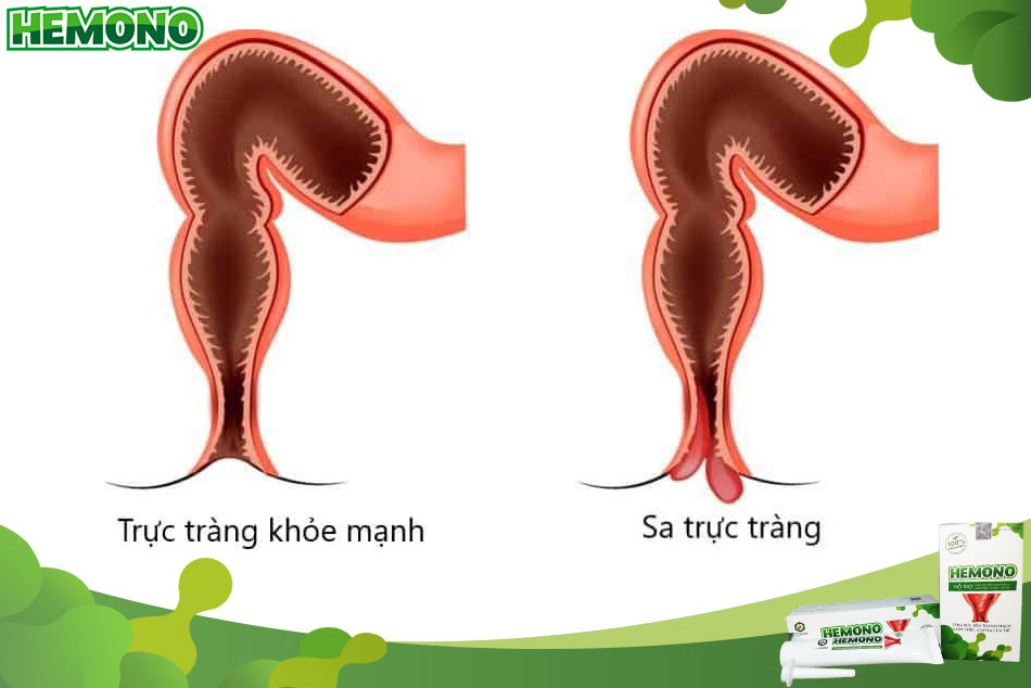 Nguyên nhân dẫn đến tình trạng sa trực tràng là gì?