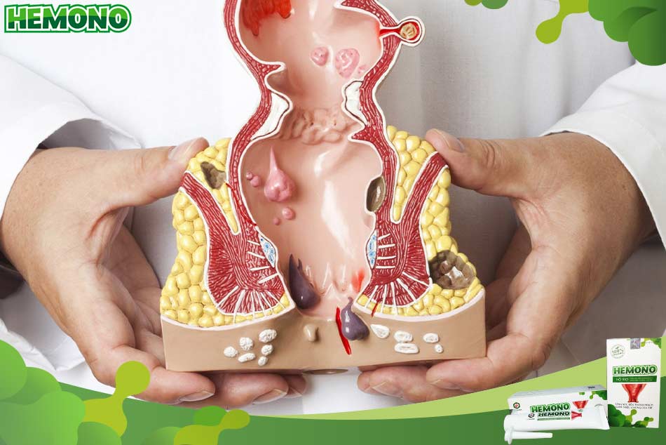 Bệnh nhân có nên sử dụng thuốc đặt hậu môn để điều trị bệnh trĩ?