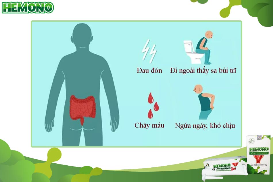 Biểu hiện của bệnh trĩ vòng