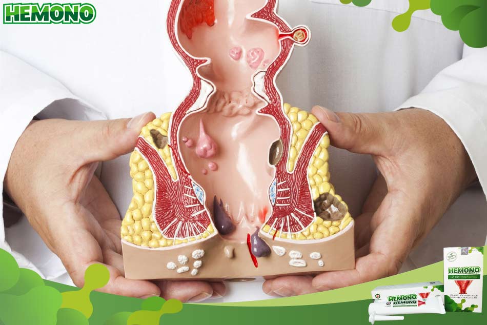 Phòng ngừa bệnh trĩ đúng cách