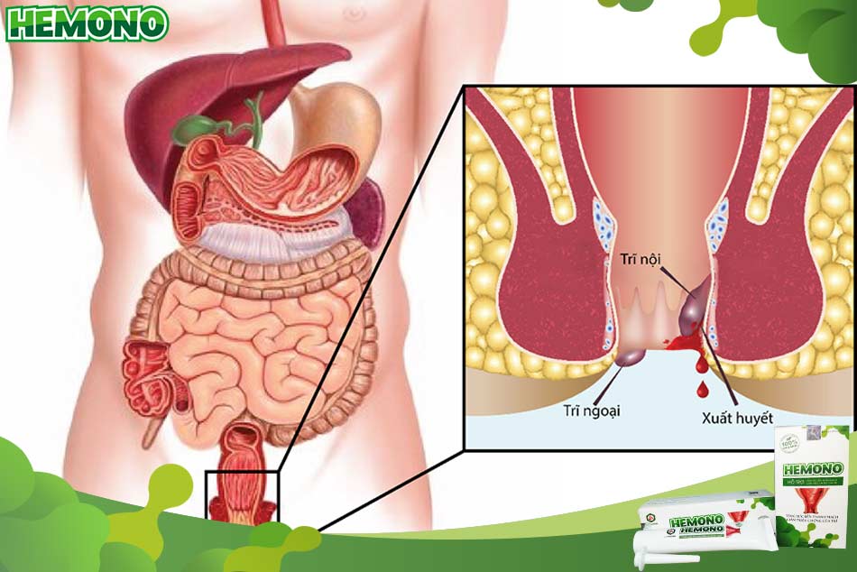 Bệnh trĩ là gì?