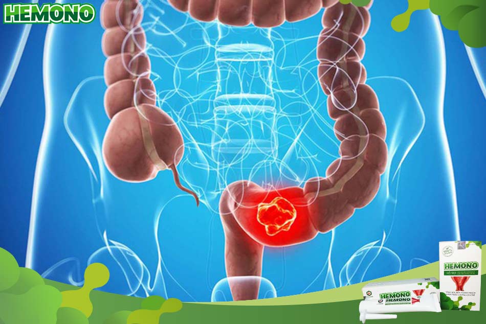 Một trong những biến chứng nguy hiểm của bệnh trĩ là ung thư trực tràng