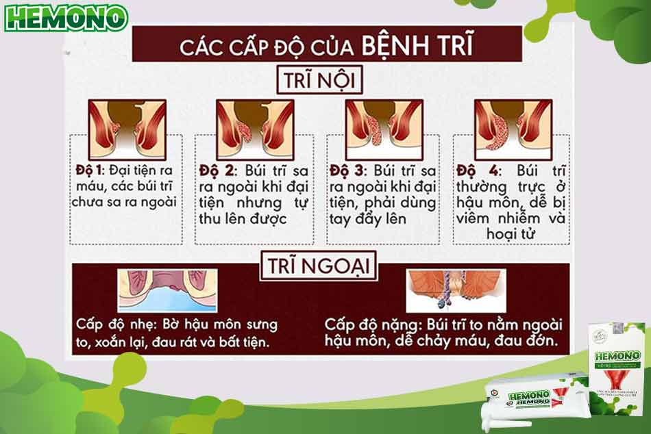 Các mức độ của bệnh trĩ