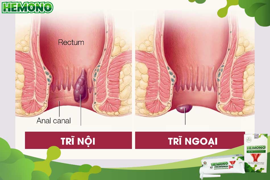 Cách nhận biết trĩ nội và trĩ ngoại