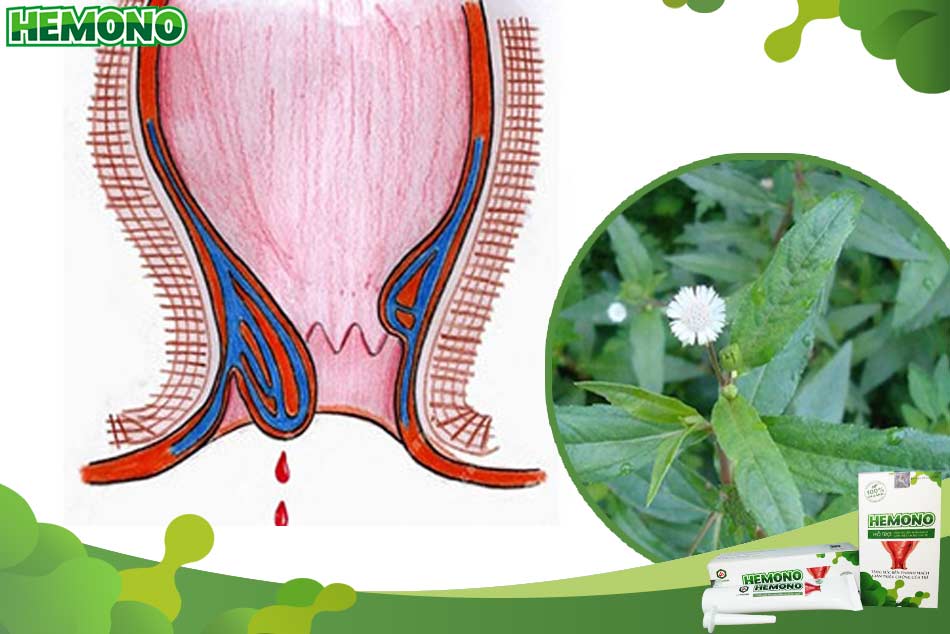 Cầm máu khi bị trĩ bằng cỏ mực