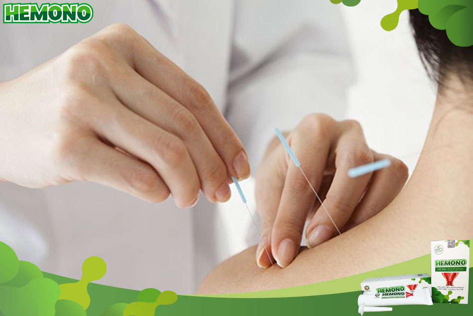 Chữa bệnh trĩ bằng phương pháp châm cứu
