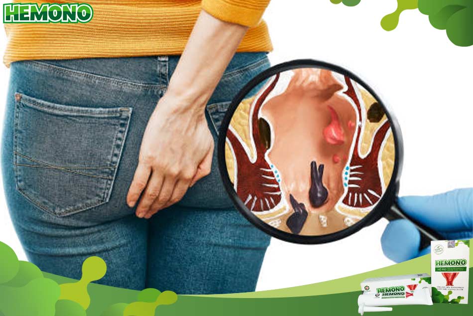 Đau hậu môn vô căn có thể là dấu hiệu của bệnh trĩ