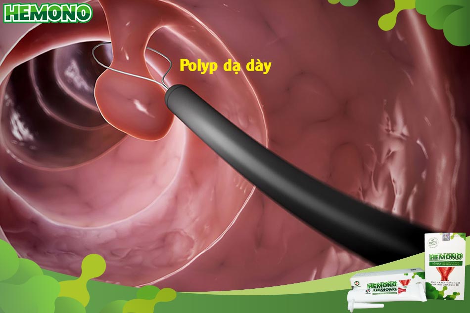 Đi cầu ra máu tươi do Polyp dạ dày