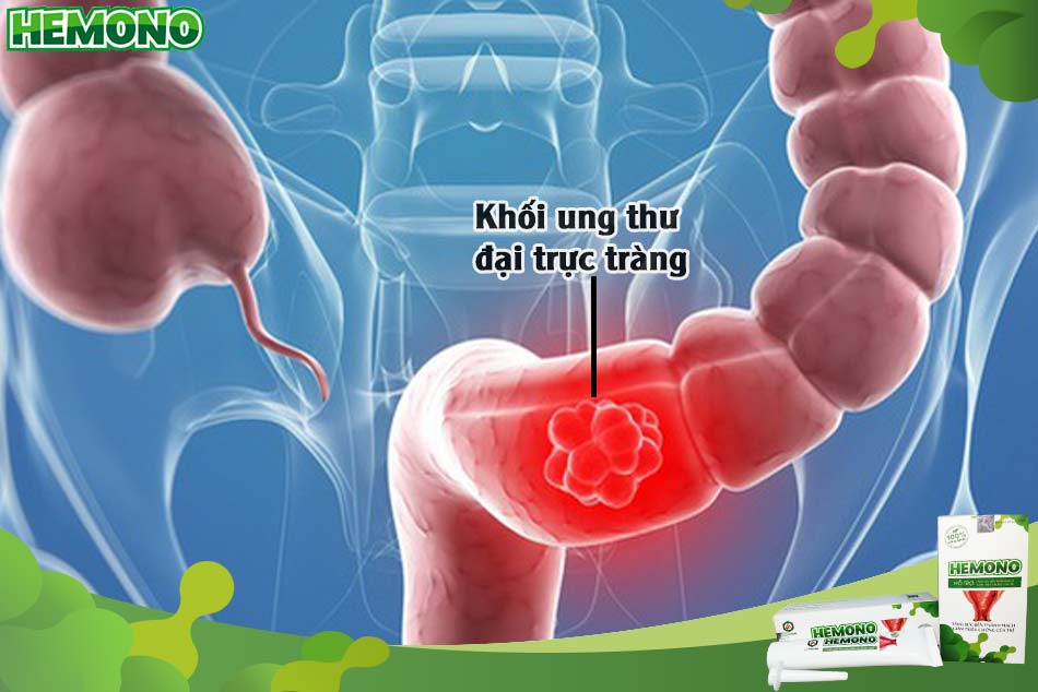 Khối ung thư đại trực tràng