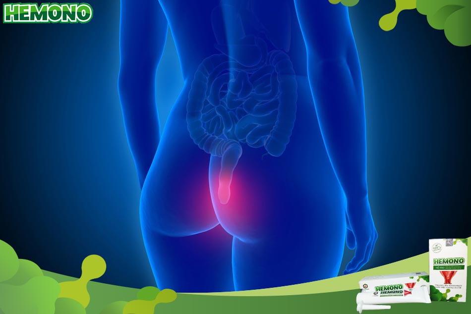 Nguyên tắc chung và phác đồ điều trị bệnh trĩ