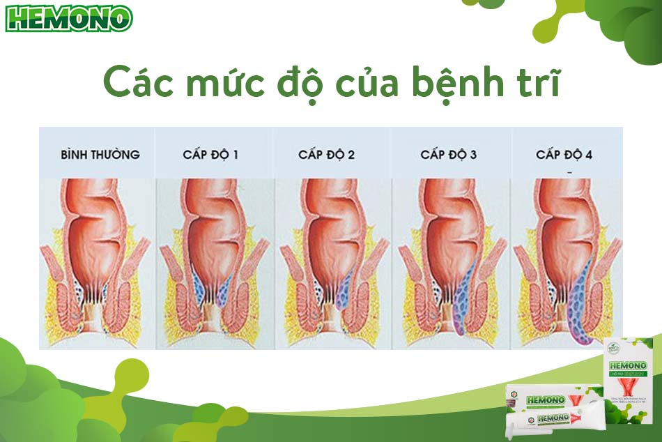 Các mức độ của bệnh trĩ