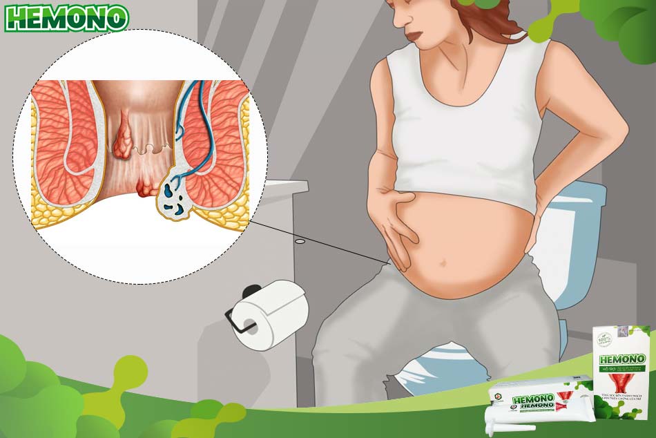 Bệnh trĩ ở phụ nữ mang thai rất thường gặp