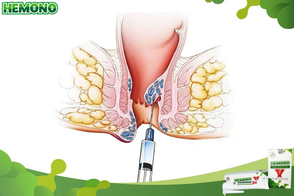 Biến chứng có thể gặp sau khi tiêm xơ búi trĩ