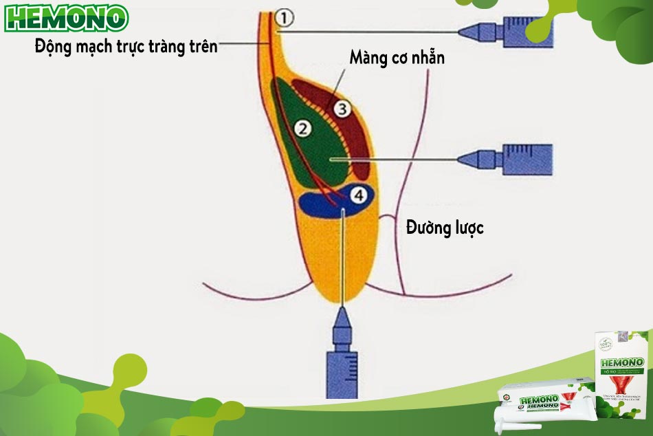 Quy trình thực hiện tiêm xơ búi trĩ