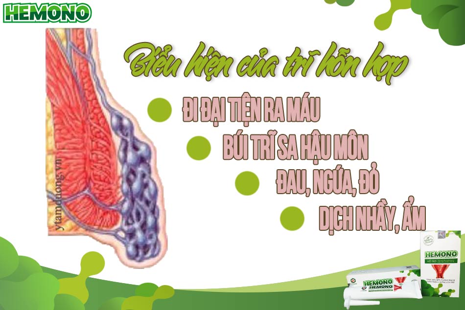 Biểu hiện của trĩ hỗn hợp