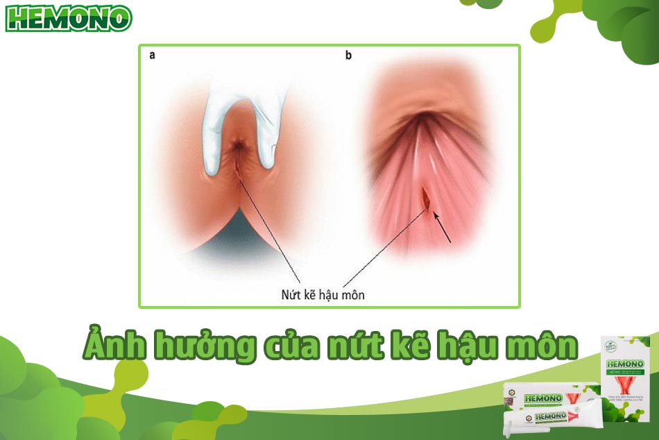 Ảnh hưởng của nứt kẽ hậu môn