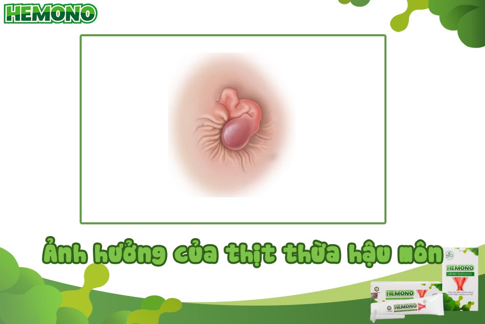 Ảnh hưởng của thịt thừa hậu môn