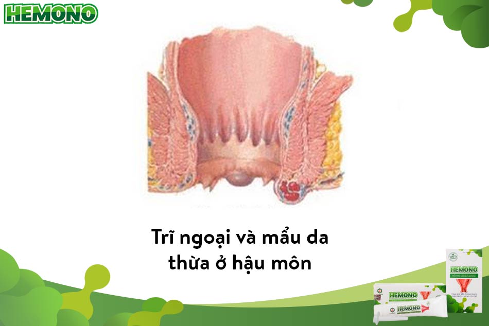 Hình ảnh bệnh trĩ ngoại