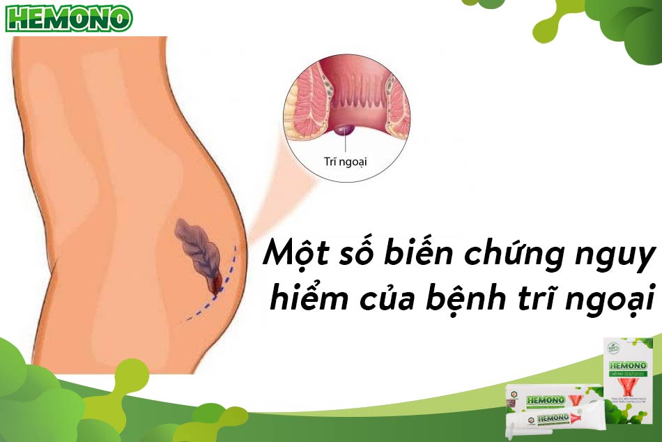 Một số biến chứng nguy hiểm của bệnh trĩ ngoại
