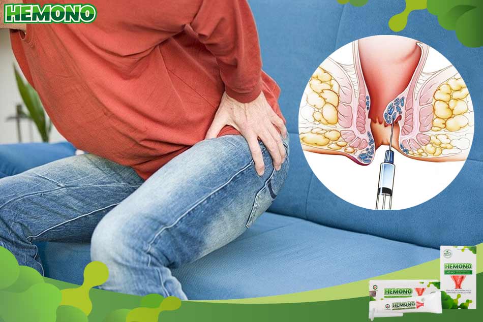 Tiêm xơ búi trĩ là một phương pháp điều trị trĩ ngoại hiện nay