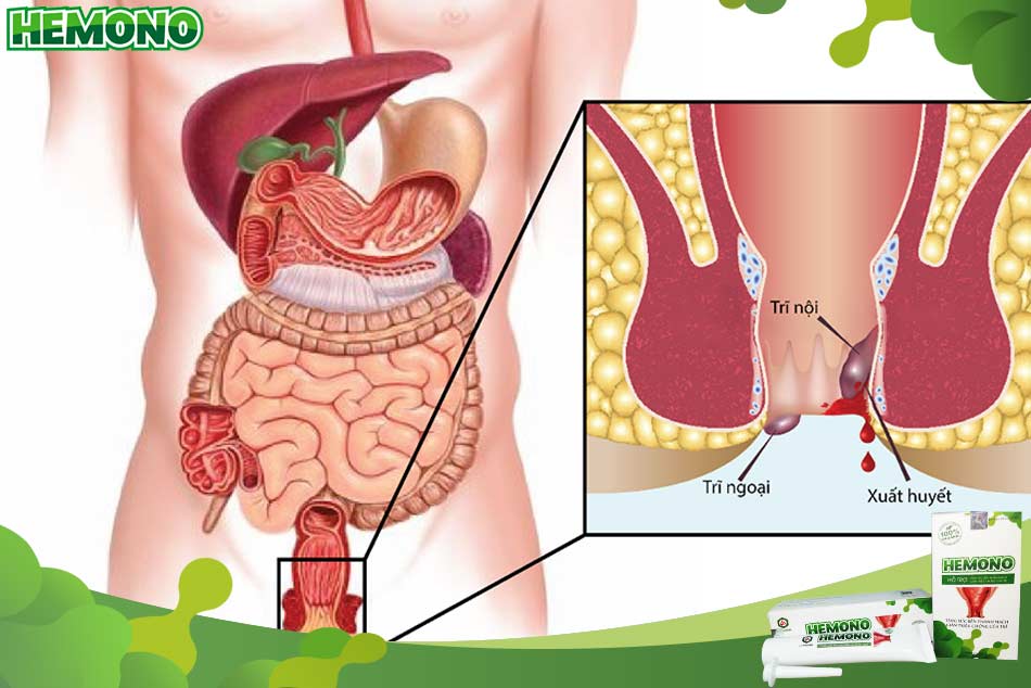 Tại sao bà bầu dễ mắc trĩ?