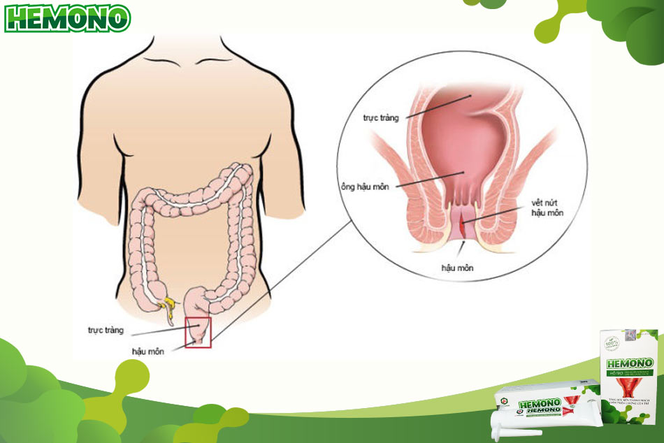 Nứt kẽ hậu môn