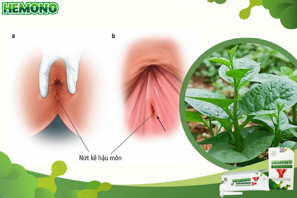 Trị nứt kẽ hậu môn bằng lá mồng tơi