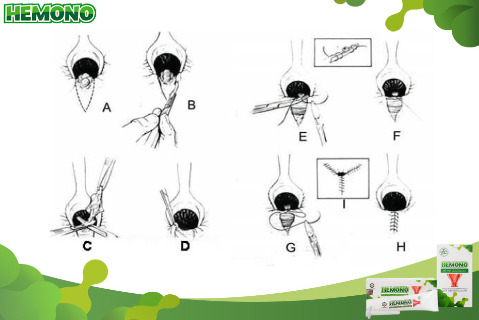 Các bước thực hiện phương pháp cắt trĩ Ferguson