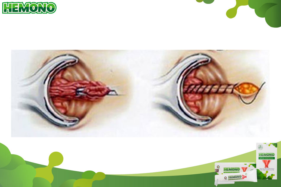 Ưu, nhược điểm của phương pháp cắt trĩ Ferguson