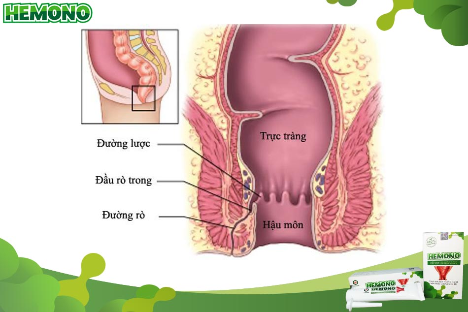 Hình ảnh rò hậu môn