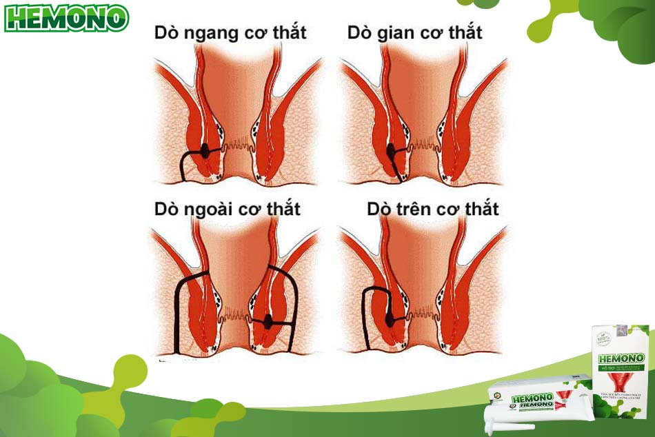Các loại rò hậu môn