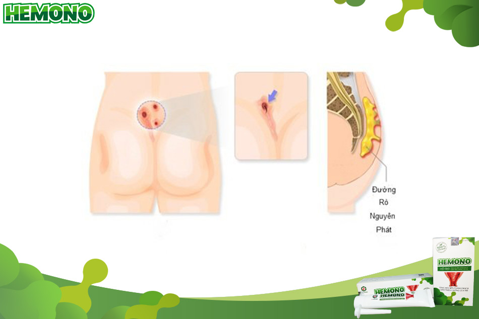 Hình ảnh đường rò nguyên phát